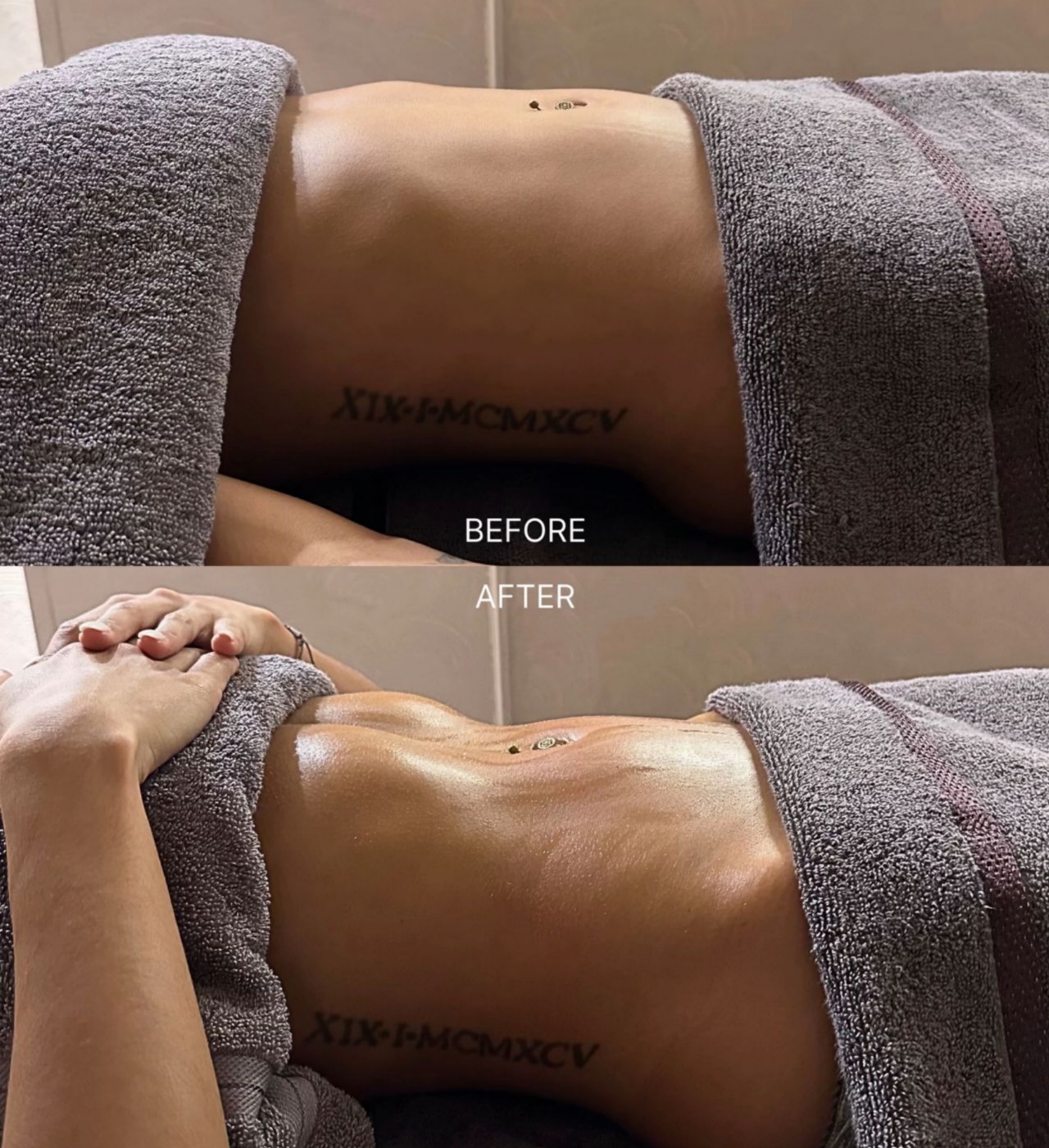 Tummy Tuck Recovery — before and after lymphatic drainage