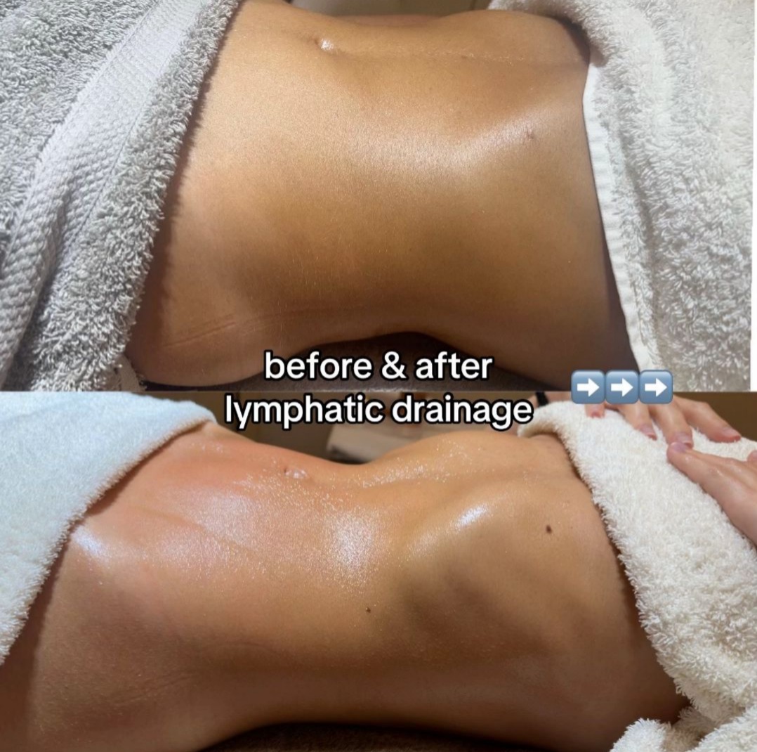 Swelling Reduction — before and after lymphatic drainage